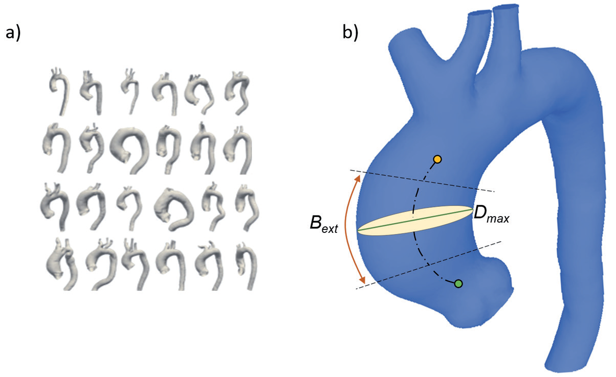 statistical aneurysmatic aorta